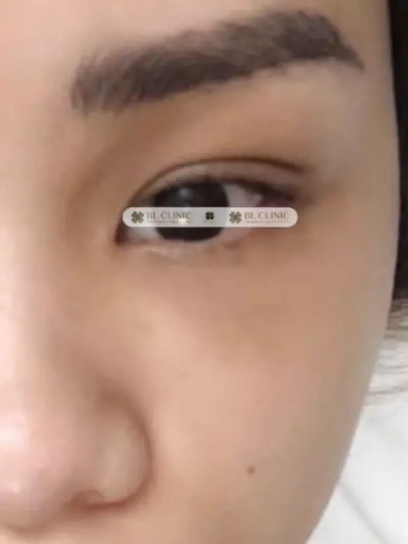 Cấy chỉ xoá nhăn mắt