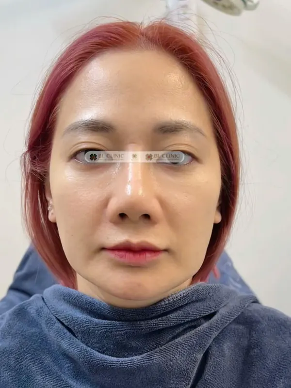 Kích thích tăng sinh collagen