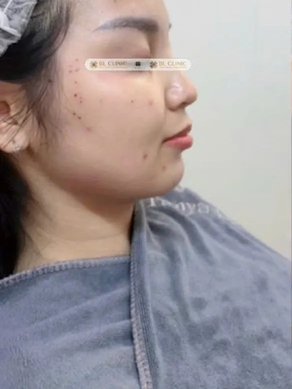 Trước