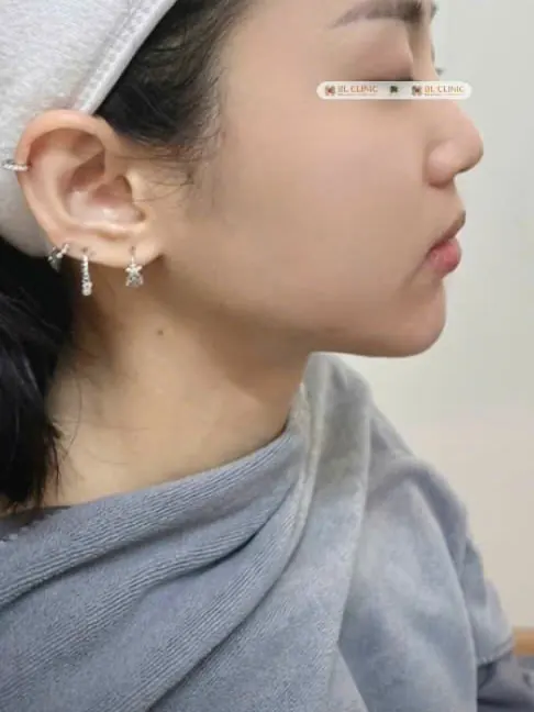Làm đầy & tạo hình gương mặt bằng Filler HA