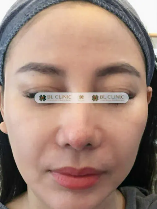 Trước