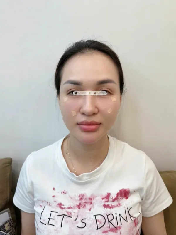 Trẻ hoá da bằng tiêm