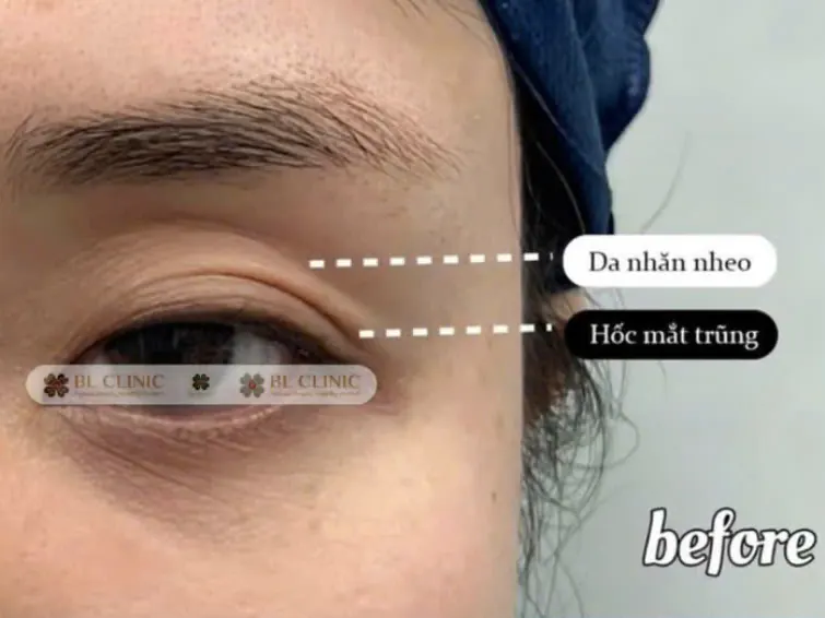 Trước