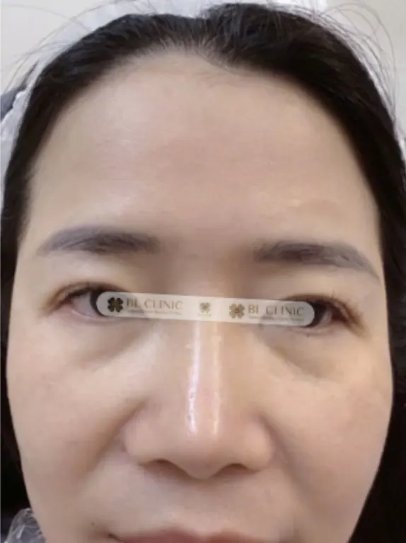 Trước