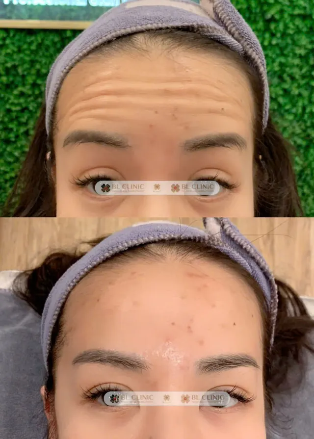 Xoá nhăn động bằng Botulinum toxin