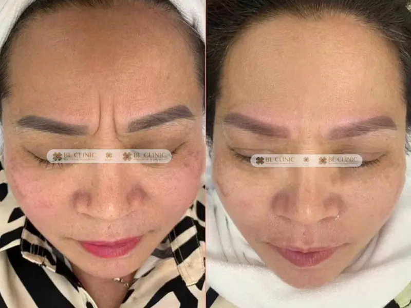 Xoá nhăn động bằng Botulinum toxin