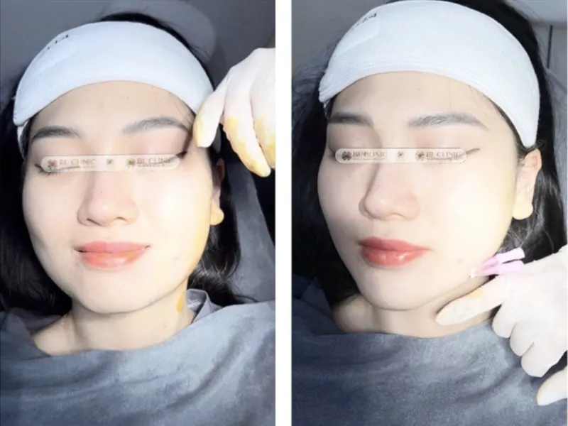 Căng chỉ nâng đỡ mô mềm