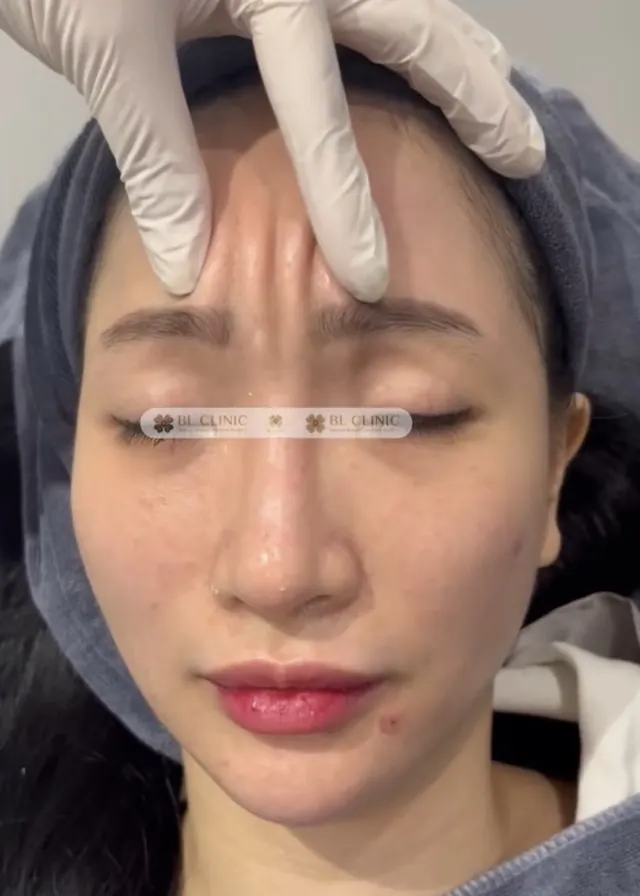 Cấy chỉ ấn đường