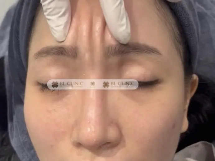 Cấy chỉ ấn đường
