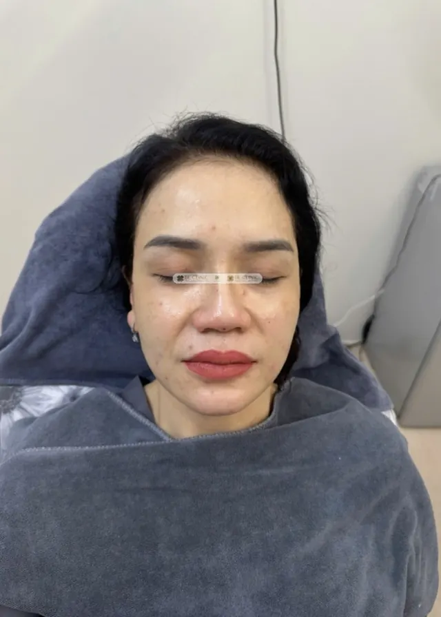 Cấy chỉ Full Face