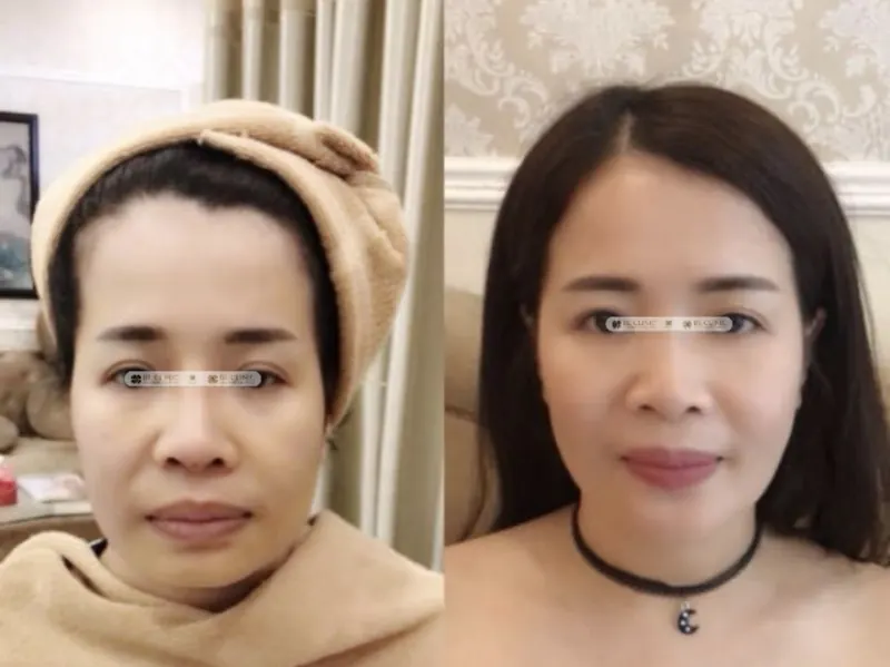 Cấy chỉ Full Face