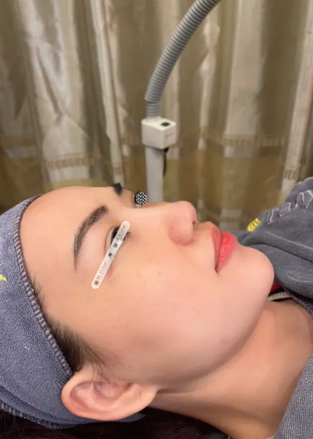 Cấy chỉ mũi