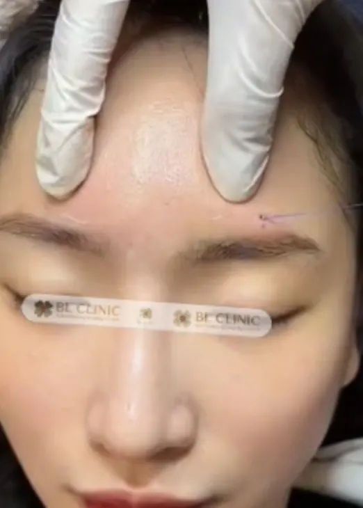 Cấy chỉ tròn trán