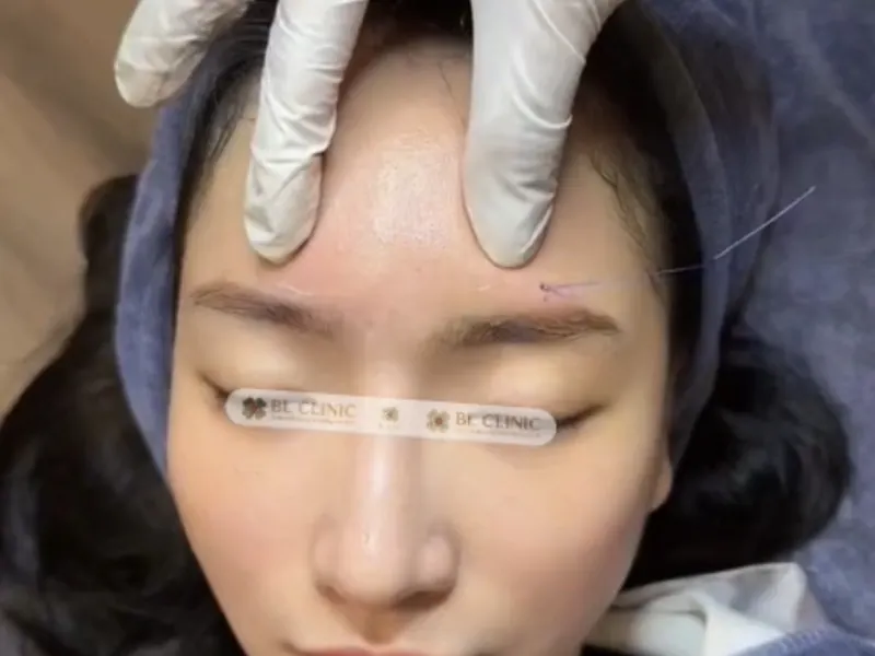 Cấy chỉ tròn trán