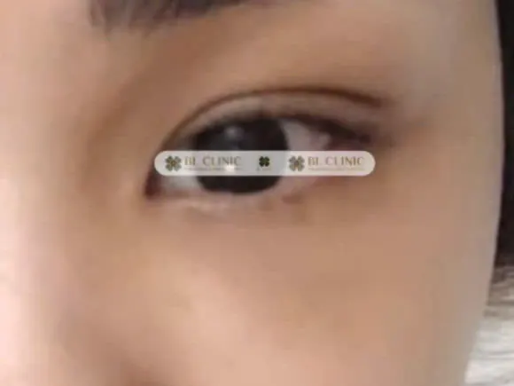 Cấy chỉ xoá nhăn mắt