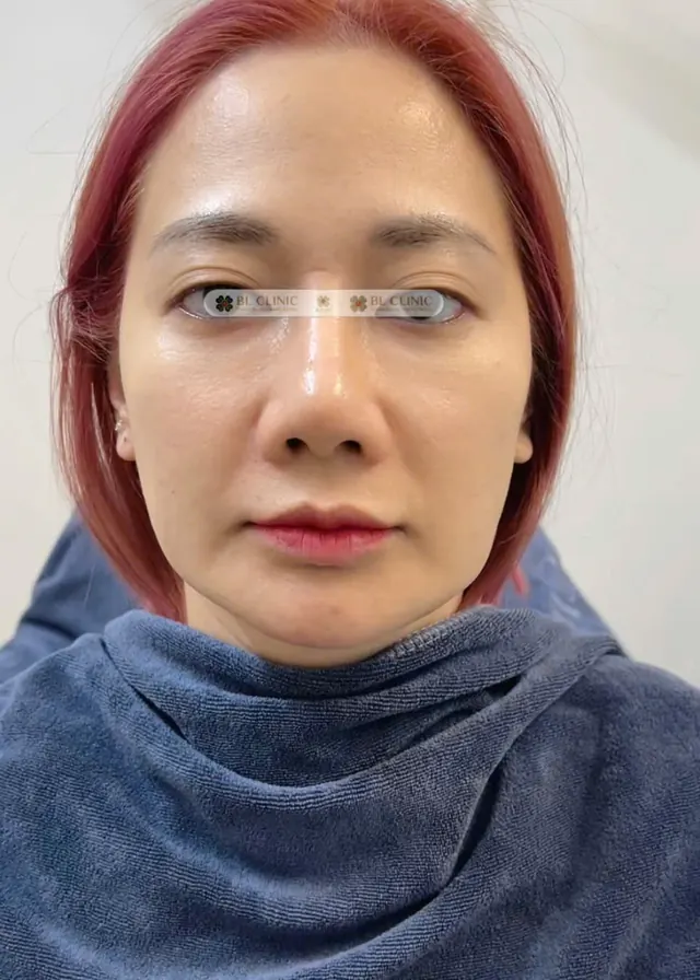 Kích thích tăng sinh collagen
