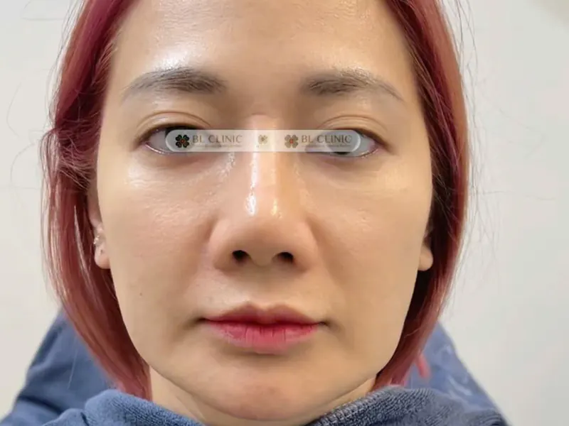 Kích thích tăng sinh collagen