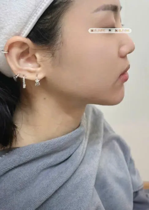 Làm đầy & tạo hình gương mặt bằng Filler HA