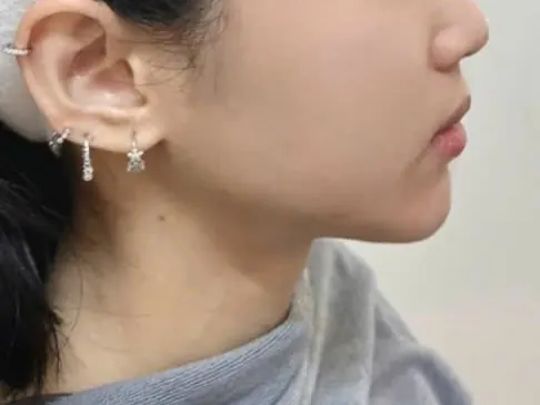 Làm đầy & tạo hình gương mặt bằng Filler HA