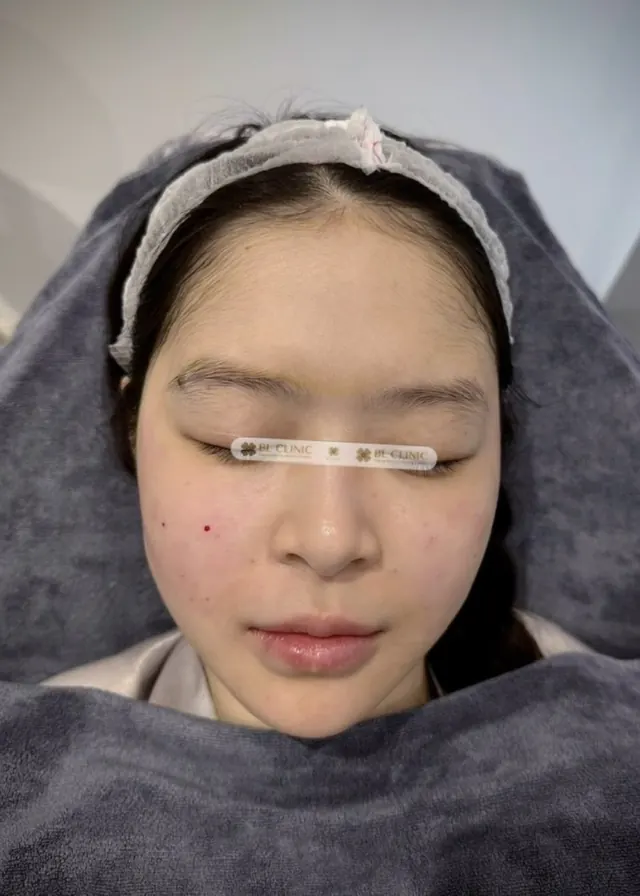Nâng đỡ & trẻ hoá vùng mặt giữa