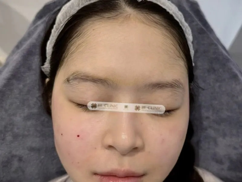 Nâng đỡ & trẻ hoá vùng mặt giữa