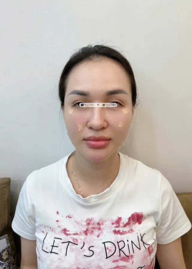 Trẻ hoá da bằng tiêm